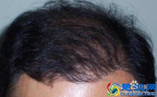 经常掉头发是什么原因 掉头发很厉害怎么办