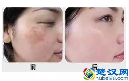 和光子嫩肤有关的核心问题，看这篇就够了！