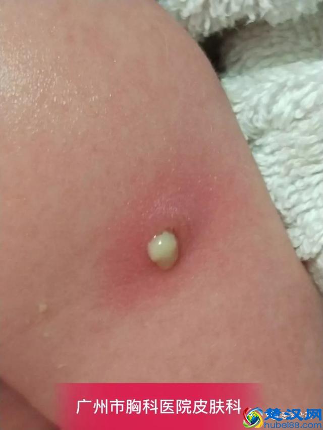 卡介苗接种后,父母需要注意什么?