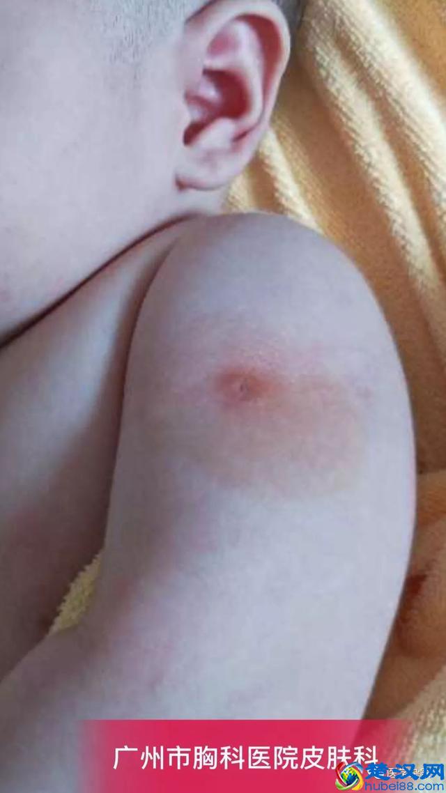 卡介苗接种后,父母需要注意什么?