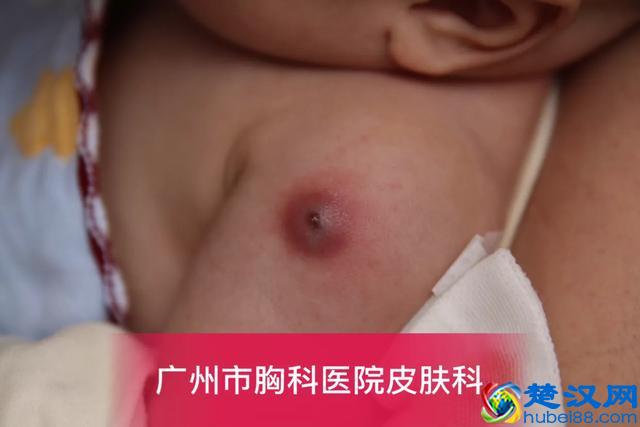 卡介苗接种后,父母需要注意什么?