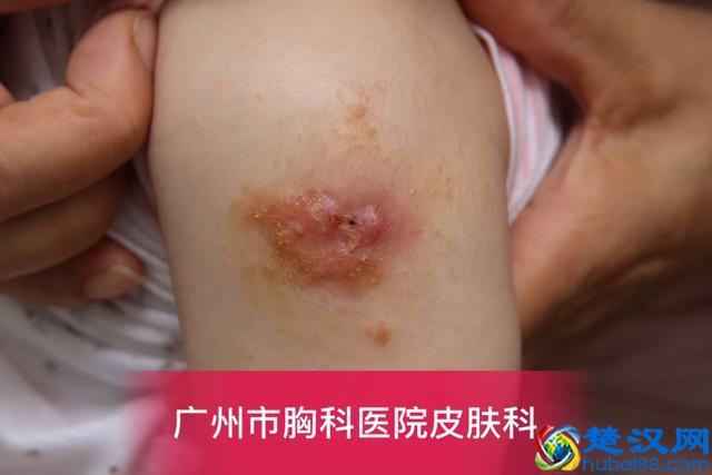 卡介苗接种后,父母需要注意什么?