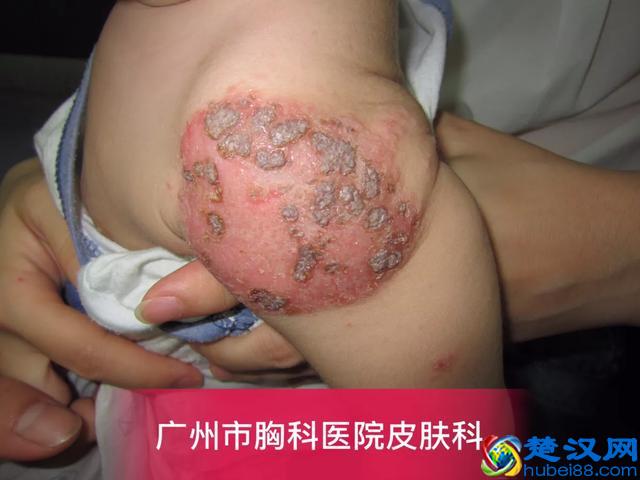 卡介苗接种后,父母需要注意什么?