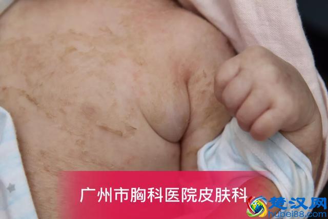 卡介苗接种后,父母需要注意什么?