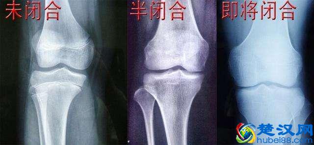 20岁之后还能继续长高吗？不瞒您说：几率很大，关键看一个地方！