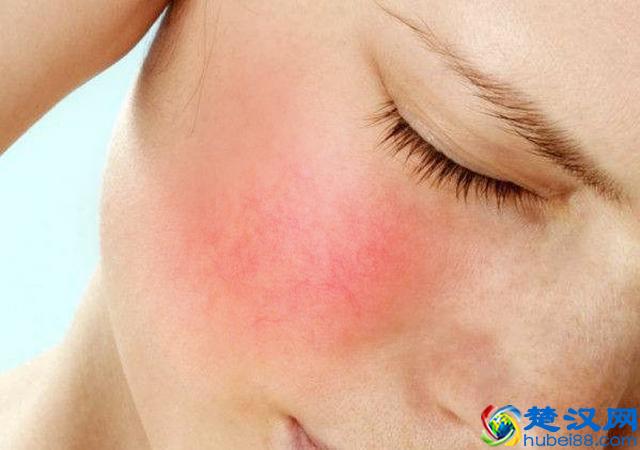 脸上有红血丝怎么办？仅需三招彻底摆脱红血丝！