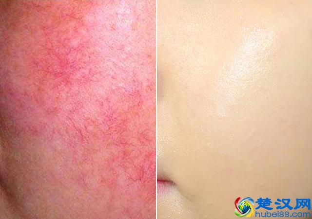 脸上有红血丝怎么办？仅需三招彻底摆脱红血丝！