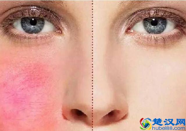 脸上有红血丝怎么办？仅需三招彻底摆脱红血丝！