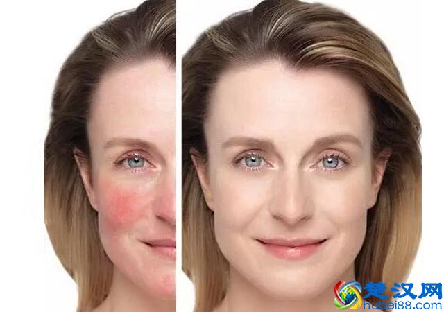 脸上有红血丝怎么办？仅需三招彻底摆脱红血丝！