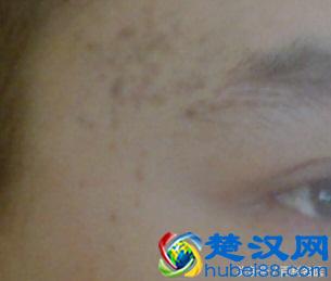 脸上不同部位长斑都是什么原因引起的，你知道吗？