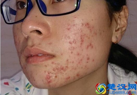 下巴长痘痘是什么原因,有什么祛痘的方法?!