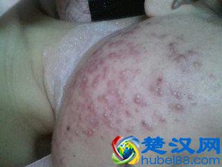 下巴长痘痘是什么原因,有什么祛痘的方法?!