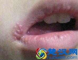 嘴角起泡是什么原因？如何快速恢复？