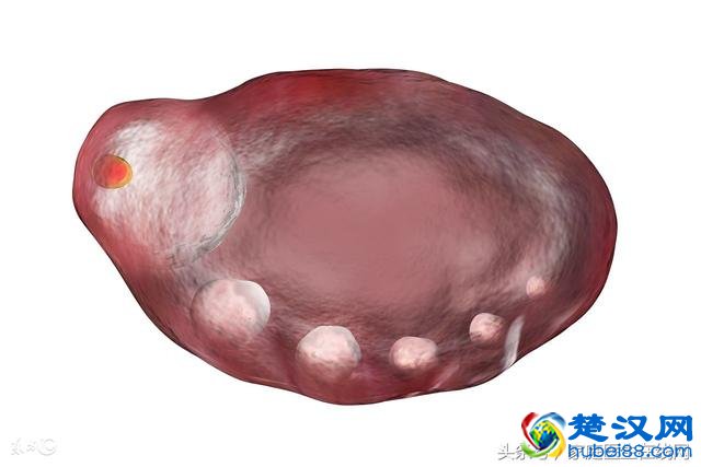 检查出多囊卵巢一定要治疗吗？这个建议你该听听