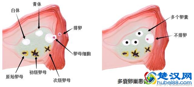 检查出多囊卵巢一定要治疗吗？这个建议你该听听