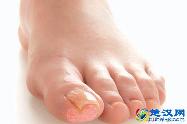 脚臭用什么泡脚？这样治疗更彻底！