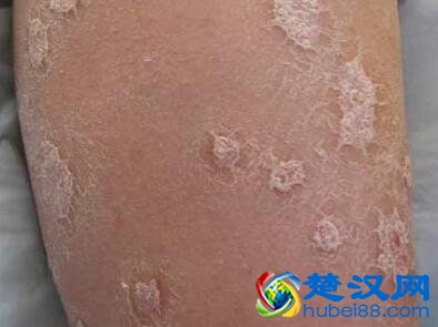 牛皮癣的症状及治疗方法，不要再相信那些“根治牛皮癣”的广告啦