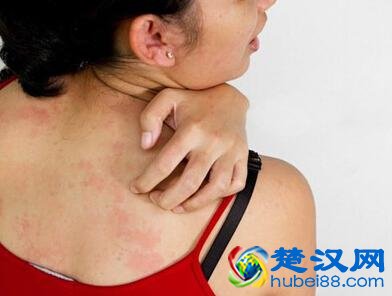 牛皮癣的症状及治疗方法，不要再相信那些“根治牛皮癣”的广告啦