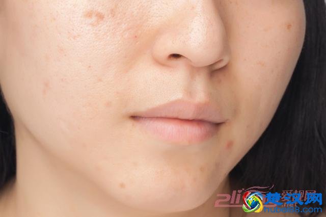 黄褐斑能彻底去除吗？治疗黄褐斑的土方法