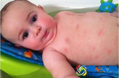 婴儿湿疹的成因及护理