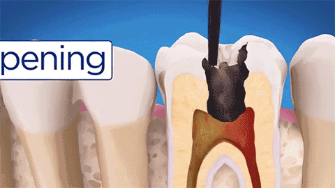 牙齿做根管治疗到底有多恐怖？