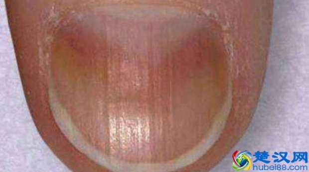  手指指甲上有竖纹是怎么回事（主要是这个原因）