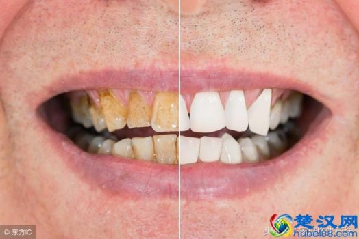  牙齿黄怎么办，简单一招，不要洗牙就可以美白！
