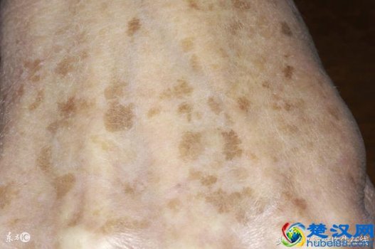  脸上长老年斑怎么办，可以试试这几个办法！