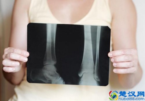  骨折后吃什么恢复最快，吃这3种食物最补