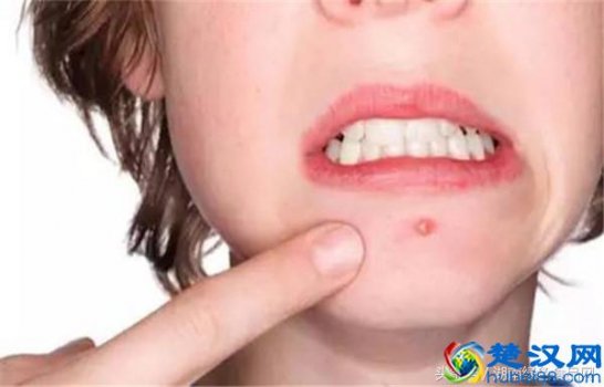  肝火旺长痘怎么调理？4招教你告别满脸痘痘