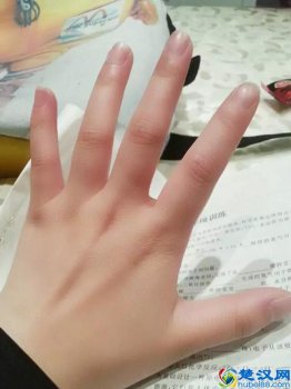  手长冻疮了怎么办？三个秘方教你根治冻疮
