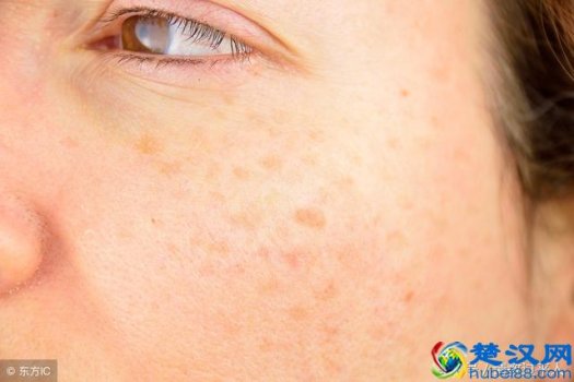  激光祛斑怎么样，分享一些祛斑心得！