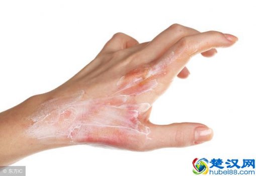  烫伤怎么处理，紧急处理方法！