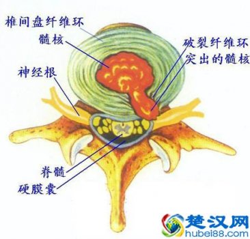  腰间盘突出怎么治疗，不花钱在家就可以解决！