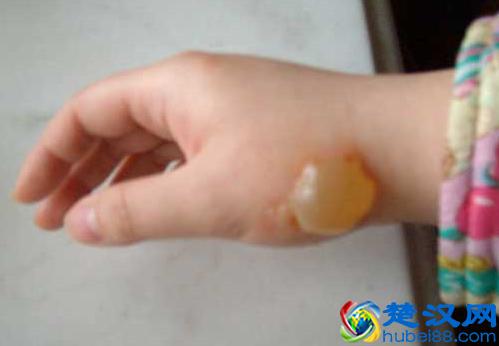  烫伤水泡怎么处理，注意事项！