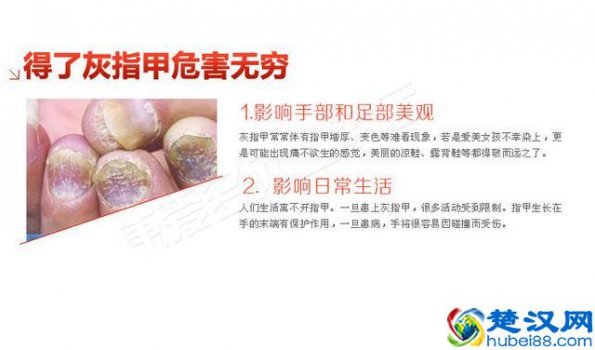  灰指甲怎么治好的快（彻底除根的治疗方法）
