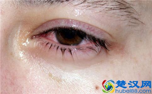 结膜炎用什么眼药水（结膜炎有哪些症状）