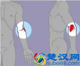  胳膊肘疼是怎么回事？一招教你三分钟解决