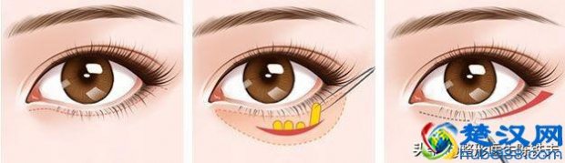  眼袋怎么形成的原因（去眼袋最有效的方法）