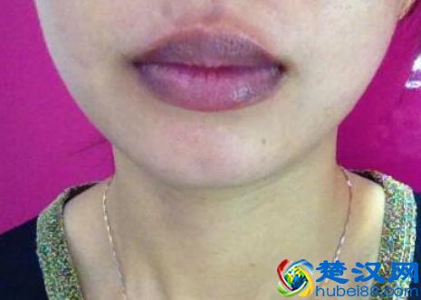  嘴唇发紫是什么原因（嘴唇的颜色可预示你身体的健康状况）