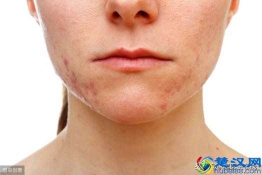  下巴长痘痘是什么原因（这5个原因，请自觉排）