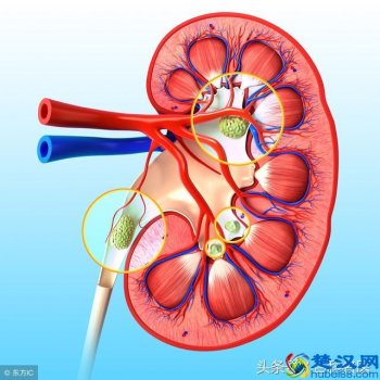  肾结石有什么症状（肾结石有哪些典型症状？）