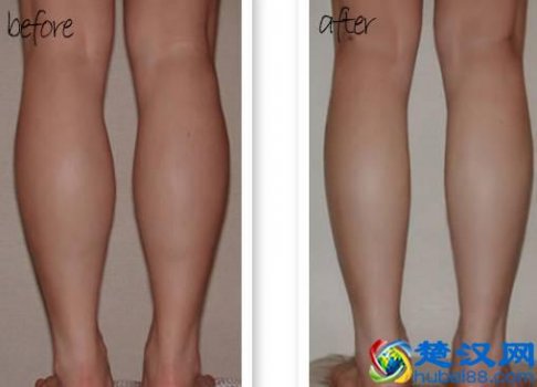  小腿肌肉怎么减？瘦腿小妙招（一个月见效）