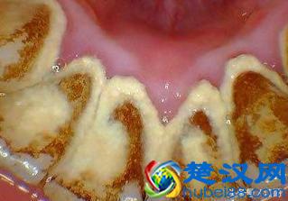  怎么去牙石？在家自己就能去牙石的方法（省钱又省事）