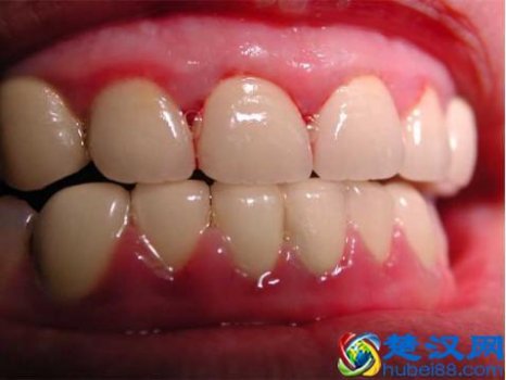  牙龈肿痛吃什么药（快速消炎的好方法推荐）