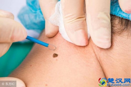  点痣后要注意什么（点痣后多久可以洗脸）