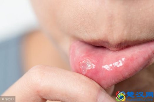 经常口腔溃疡是什么原因（别以为是上火，小心这些大问题）