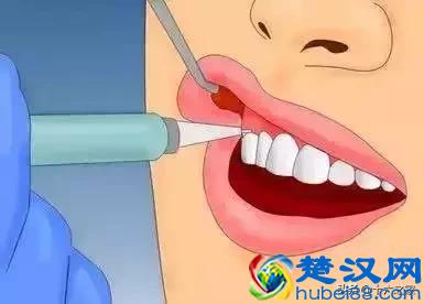  阻生牙拔除术费用（阻生牙拔除术手术流程以及术后注意事项）