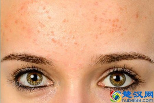  14岁孩子额头长痘怎么办（孩子青春期额头有粉刺）