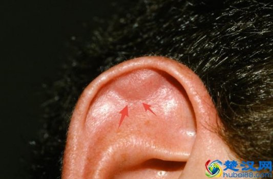  耳朵后面长疙瘩，几种原因不可大意！